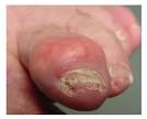 Gouty Arthritis