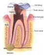 Endodontic Treatment | Root Canal Surgery | Warren Dentistry