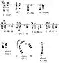 <b>Ataxia telangiectasia</b>