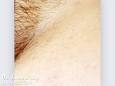 bikini-hair-removal-before. ...
