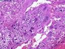 Slide: Choriocarcinoma | Webpathology.