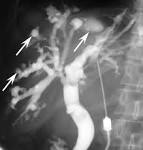 <b>Caroli disease</b>.