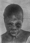 <b>Syphilis</b> lesions on a