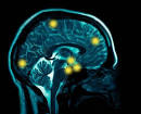 Brain Scan Using Avid's Radioactive Dye Capable of Detecting ...
