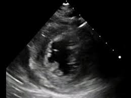 Image result for Capillary leak syndrome echocardiography and ultrasound
