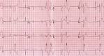 Ventricular premature complex (VPC) in couplet | Cardiophile MD