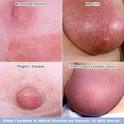 http://www.riversideonline.com/source/images/image_popup/ans7_breast_rash.jpg