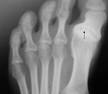 progressive <b>Hallux varus</b>