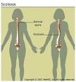 When a person with <b>scoliosis</b>