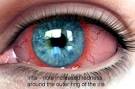 <b>iritis</b> anterior uveitis