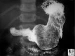 LearningRadiology.com - Bezoar, Trichobezoar, Hairball, Fiber ...