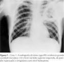 01 – <b>ABSCESSO PULMONAR</b>