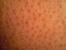 THIGH: keratosis pilaris