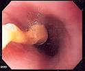 File:Food bolus obstruction.jpg - Wikipedia, the free encyclopedia