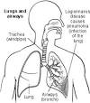 LEGIONNAIRES DISEASE – Symptoms, Causes, Tests, Prevention and ...