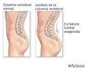 <b>Lordosis</b>