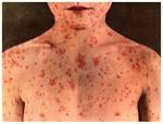 CDC warns of large outbreak of measles | Nwo Report