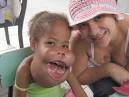 Deformity Facts, information, pictures | Encyclopedia.com articles ...