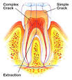 <b>Cracked Tooth Syndrome</b>