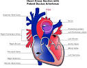 File:Patent <b>ductus arteriosus</b>.