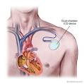 Boston Scientific :: ICD (Defibrillator) Implantation
