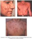  Your Last Acne Solution   When Nothing Works On Acne, What Would You Do?