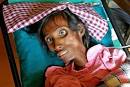 ARV diseases