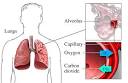 Fluid in Lung Causes – Pleurisy and Fluid Lungs Treatment