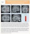 Auditory Hallucinations in Psychiatric Illness - Psychiatric Times