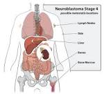 <b>Neuroblastoma</b> Stage 4