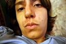  Some Tips About Acne Treatment Systems