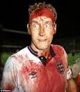Football scars have I many.