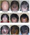 ATLANTA HAIR LOSS | NATURAL HAIR LOSS REMEDIES | ATLANTA HAIR GROWTH