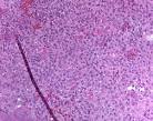 <b>Chondroblastoma</b>