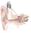 Cochlear implant - Wikipedia, the free encyclopedia