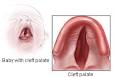 Baby with Cleft <b>Palate</b>