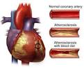Atherosclerosis - what is