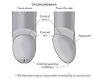 Circumcision Information - Sydney Clinic | Dr Norman Blumenthal