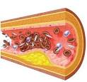 Arteriosclerosis treatment