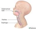 Endotracheal <b>intubation</b>