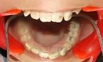 <b>Dentin dysplasia</b> type I: a