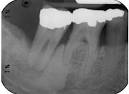 Idiopathic <b>Osteosclerosis</b>