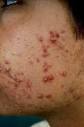  Acne   5 Myths About Causes Of Acne