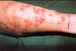 of Invasive <b>Mycoses</b> Caused