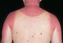  Acute Sunburn Picture Image on e Medicine Health.