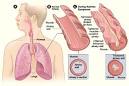 What Is Asthma? - NHLBI, NIH