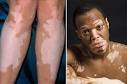VITILIGO Symptoms and Treatments help in diagnosis and cure diseases