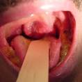 Pictures of Carcinoma and Lymphoma of the Tonsil ** Otolaryngology ...