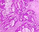 File:<b>Adenocarcinoma</b> coli.jpg - Wikimedia Commons