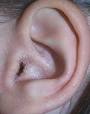 <b>Otitis externa</b> - Wikipedia